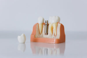 Dental Implant Background